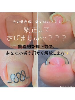 長岡巻き爪矯正センター/巻き爪矯正ビフォーアフター