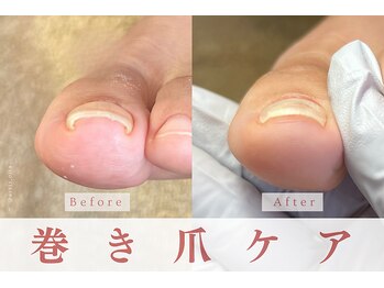 アルヴィス(Arviss)/巻き爪ケア