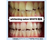 ホワイトニングサロン ホワイト(WHITE)/セルフホワイトニング/大阪/福島