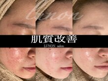 ルノン(Lunon)/肌質改善　《症例》