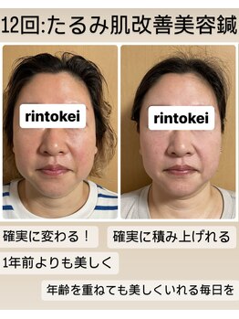 凛と慶/たるみ肌改善美容鍼