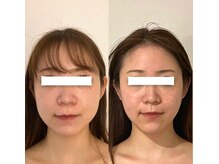 ハイコガオ(HIKOGAO)/小顔矯正40分