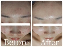 サロン ド ヒノキ(Salon de HINOKI)/ニキビケア☆ハーブピーリング