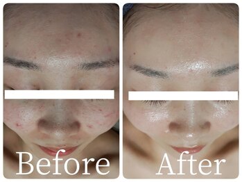 サロン ド ヒノキ(Salon de HINOKI)/ニキビケア☆ハーブピーリング