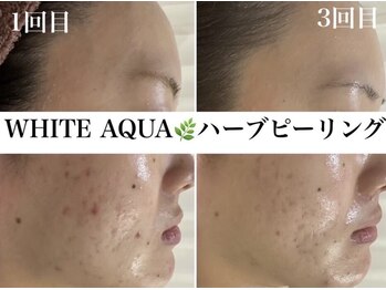ホワイトアクア 浜松店(WHITE AQUA)/ハーブピーリング/ニキビケア