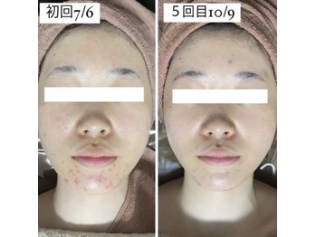 ホワイトアクア 岐阜店(WHITE AQUA)/ハーブピーリング/岐阜/ニキビ