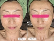 スローガーデン(Slow Garden)/炭酸パックビフォーアフター