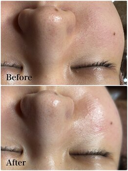 エッセンシャル 南海難波店(ESSENTIAL)/【REVI】ハーブピーリング