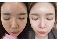 リュクシー(LuxeY)/インセルダム7日間使用