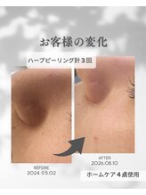 プレジール(Plaisir)/お手入れ3回・ホームケア使用