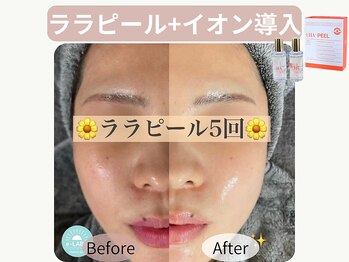 イーラボ 池袋店(e-LABO)の写真/【韓国式肌管理《ララピール&プラピール》で徹底美肌】本気の陶器肌!毛穴・ニキビケア・美白のトリプルケア