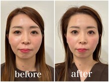 鍼グリッター 岡山本院(鍼Glitter.)/[ビフォーアフター]美容鍼