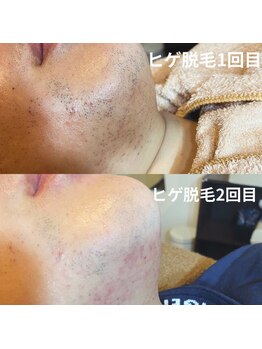 アルト(ALTO)/リピーター様