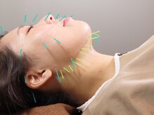 カラダキュア 東京銀座/美容鍼と真皮鍼