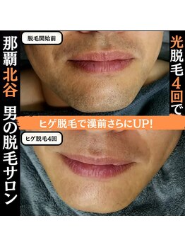 ディースタイル 北谷店(Dstyle)/北谷メンズ脱毛ヒゲBefore after
