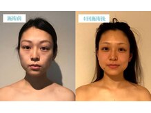 マリーボーテ 名古屋店/【小顔４回】美人度を格上げ