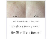 シミリセット 名駅(シミReset)/コンシーラー卒業