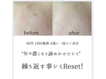 シミリセット 名駅(シミReset)/コンシーラー卒業