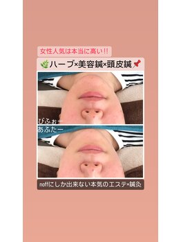 ノフ 恵比寿(noff)/美容鍼効果