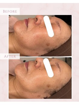 プレジール(Plaisir)/サーマトリックス+ララピールLDM