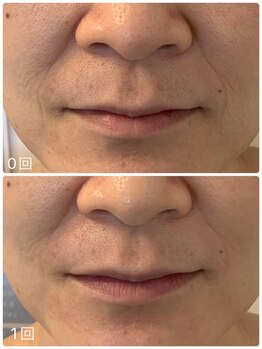 プリュネル(Prunelle)/プラズマシャワー