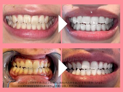 ホワイヤ セルフホワイトニング DBS神楽坂(Whi-Ya)の写真