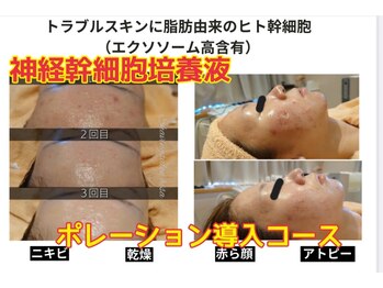 ハナン(Hanan)/人気No1!幹細胞&ポレーション