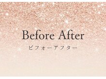 La　cachette/ピーリング症例