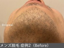 オアシスラグーン(OASIS LAGOON)/メンズ脱毛（症例2 before）