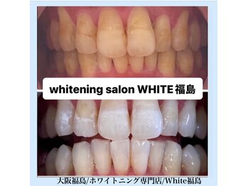 ホワイトニングサロン ホワイト(WHITE)/セルフホワイトニング/大阪/福島