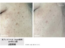 キュー(cue)/光フェイシャル