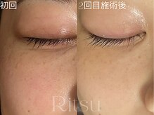 リツ(Ritsu)/シミケア/シミケア当て放題