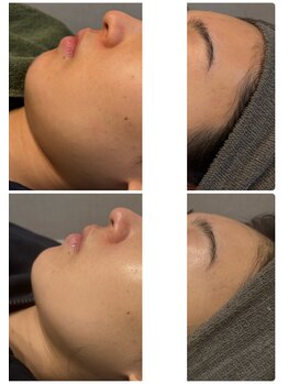 アロラヴィ(AroRavi)/肌質改善プログラム