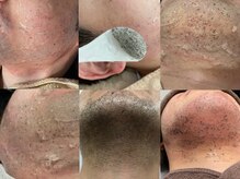 脱毛専門サロン エリクサー(Elixir)/Before After