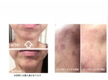 エクレボーテ(ECOULERBEAUTE)/施術例：ハーブピーリング
