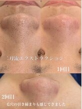 アルリシャ(Alrescha)/二刀流毛穴エクストラクション