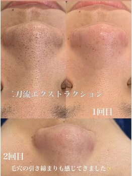 アルリシャ(Alrescha)/二刀流毛穴エクストラクション