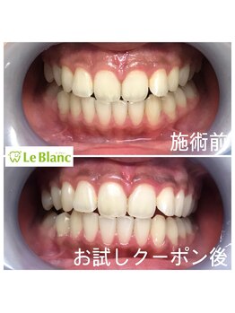 ルブラン 奈良店(Le Blanc)/削らずホワイトニング!!