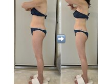 ミル(miru)/インディバ90分上半身コース/1回