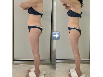 ミル(miru)/インディバ90分上半身コース/1回