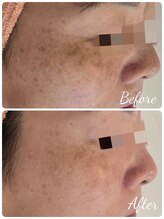 サロンド シェリー(Salon de Cherie)/LED光フェイシャル