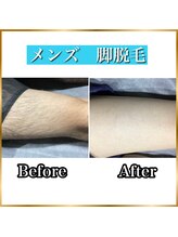 ベリッシモ 酒田店(Bellissimo)/メンズ脚脱毛ビフォーアフター