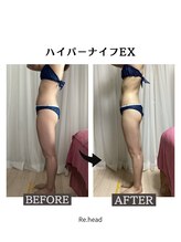 リヘッド(Re.head)/ハイパーナイフ　頑固な脂肪撃退