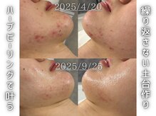 フェイシャルヴィム(FACIAL VIM)/ニキビケアにはハーブピーリング