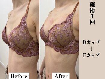 ソワ(soie)/産後のしぼみ・デコルテ削げ