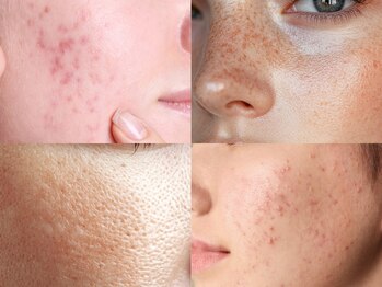 アウラプラス(Aura+)の写真/県内外からの来店多数！受賞歴のある実力派サロンで、スピーディに美肌へ導きます◎[シミケア/ニキビケア]