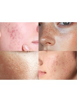 シミしわ改善！予防ケア