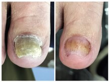 フレッシュフット(FreshFoot)/足のトラブルお任せください