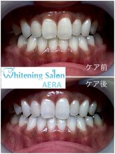 アエラ(AERA)/【メンテナンス】ホワイトニング