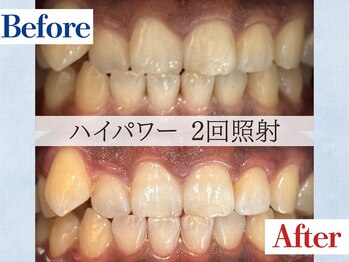 LBSホワイトニング 吉祥寺店/ホワイトニングビフォーアフター